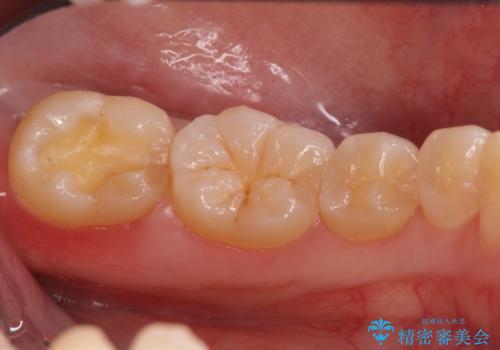 奥歯の虫歯 セラミックインレーでの治療の治療中