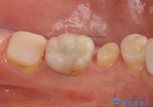 昔いれたクラウンが割れたので金属の被せ物を入れたいの治療中