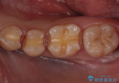 歯と歯の間の虫歯　セラミックインレーでの治療の治療中