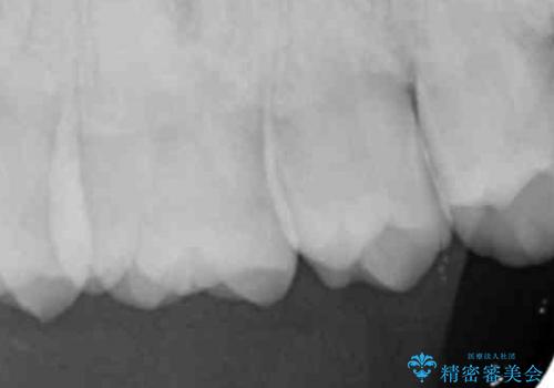 歯と歯の間の虫歯 セラミックインレーでの治療の治療前