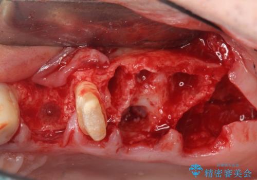 骨の造成を行った上顎インプラント治療の治療前