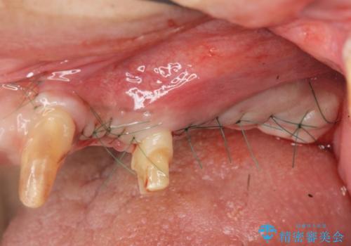 骨の造成を行った上顎インプラント治療の治療中