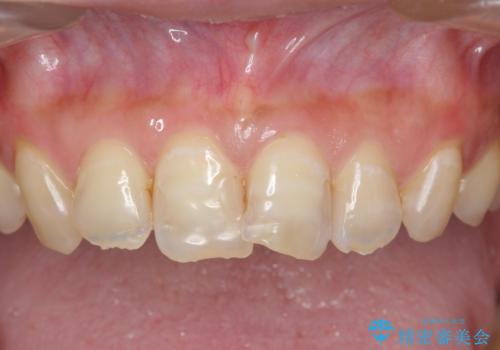 [ 審美歯科 ]  歯並び・色・形を改善!　セラミッククラウン治療の治療前