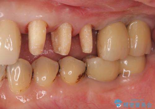 強い咬合力に対抗する歯周補綴の治療中