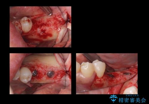 歯科でトラウマ 怖くて行っていなかったが、今度こそきちんと治療したいの治療中