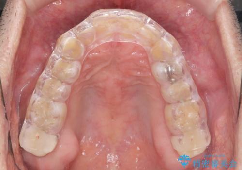 歯ぎしり　いびきに効果的なスプリントナイトガードの症例 治療後