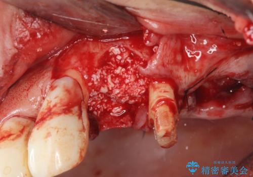 骨の造成を行った上顎インプラント治療の治療前