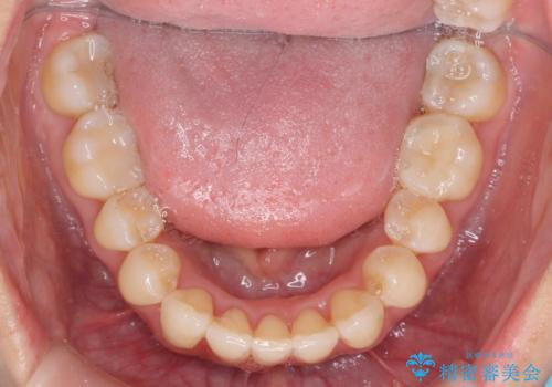 目立つ前歯のガタつきを改善!　マウスピース矯正治療の治療後