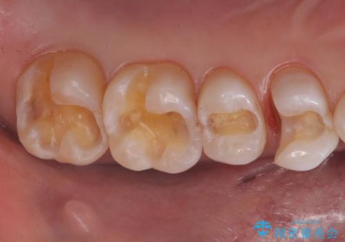 銀歯と樹脂の詰め物のやり替え　セラミックインレーでの治療の治療中