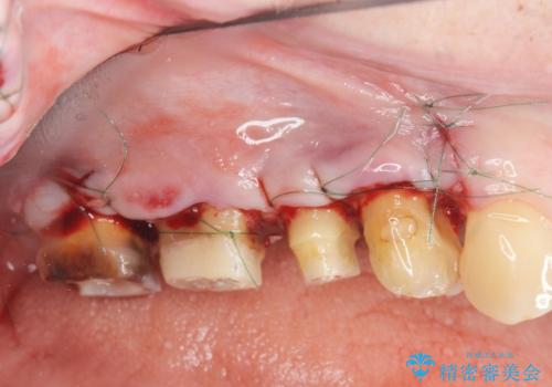 根管治療・歯周外科を行い歯を残した、複合的虫歯治療の治療前