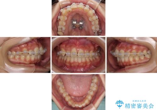【モニター】歯列が狭くデコボコが気になる 急速拡大装置を用いたインビザライン矯正の治療中
