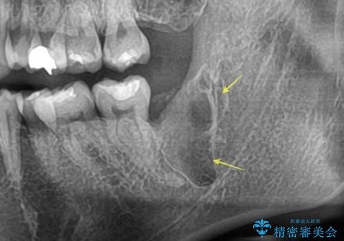 【埋伏智歯と埋伏智歯の過剰歯の抜歯】埋まっている親知らず2本の抜歯の症例 治療後