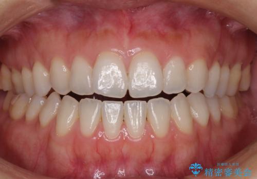 【モニター】狭い上顎歯列とオープンバイト 急速拡大装置を用いた矯正治療の症例 治療前