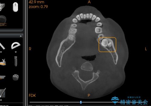 【埋伏智歯と埋伏智歯の過剰歯の抜歯】埋まっている親知らず2本の抜歯の治療前