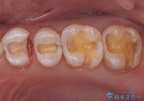 銀歯と樹脂の詰め物のやり替え セラミックインレーでの治療の治療中