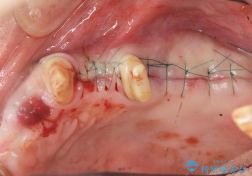 骨の造成を行った上顎インプラント治療の治療中