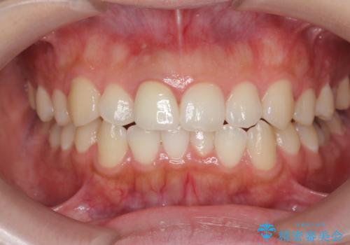 歯ぐきにできものができた　前歯の色調改善の治療後