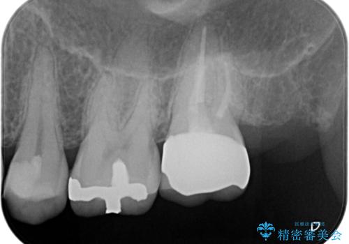 【精密根管治療】奥歯がズキズキ痛い。の治療後