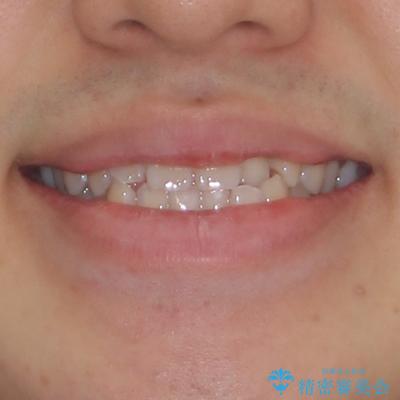 受け口傾向の咬み合わせ インビザラインできれいな口元にの治療前(顔貌)