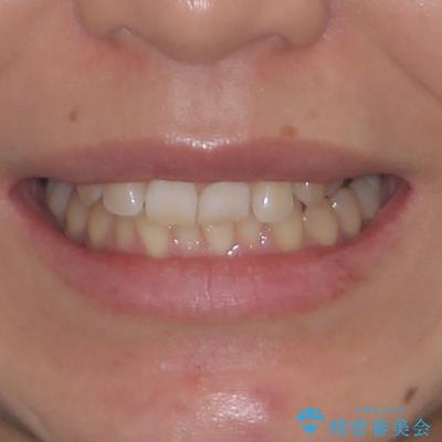カリエール・ディスタライザーとインビザラインを用いた前歯の咬み合わせ改善の治療前（顔貌）