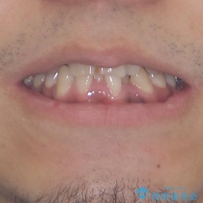 重なって磨きにくい上下の前歯 ワイヤー装置での抜歯矯正の治療前(顔貌)