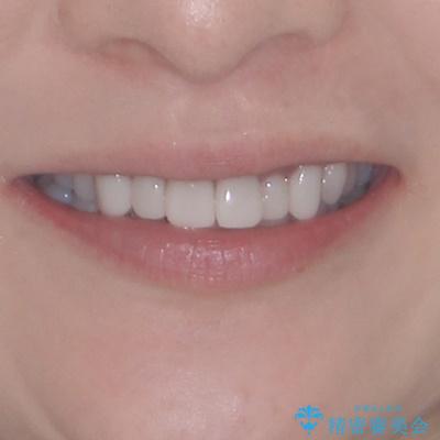 前歯のデコボコと奥歯の咬み合わせをインビザラインで改善の治療前（顔貌）