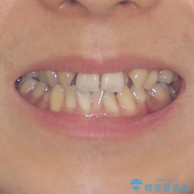 重なり合って磨きにくい前歯　ワイヤー装置での抜歯矯正の治療前（顔貌）