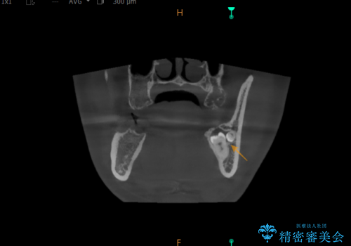 【埋伏智歯と埋伏智歯の過剰歯の抜歯】埋まっている親知らず2本の抜歯の治療前