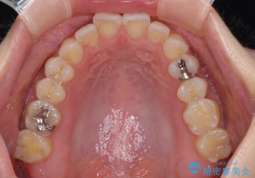【モニター】狭い上顎歯列とオープンバイト 急速拡大装置を用いた矯正治療の治療前