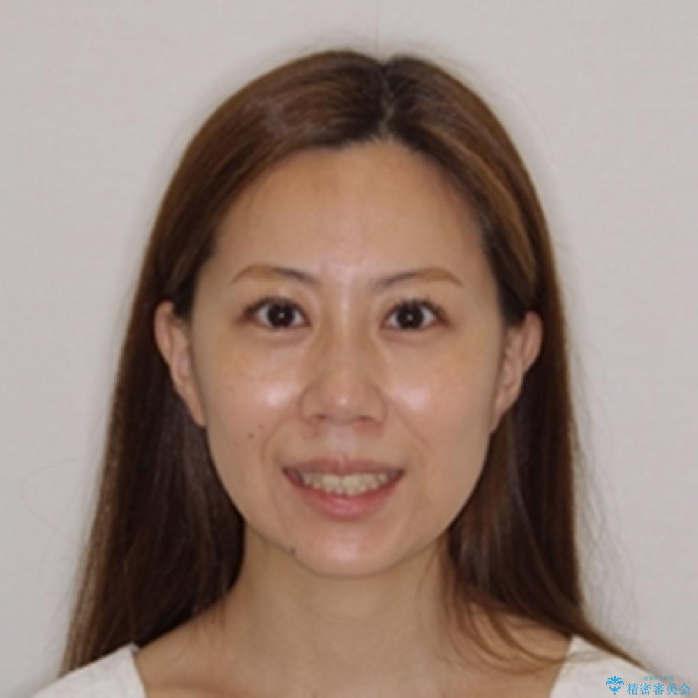 【モニター】歯列が狭くデコボコが気になる 急速拡大装置を用いたインビザライン矯正の治療前(顔貌)