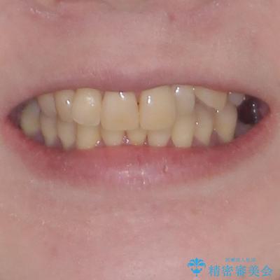 八重歯と先天欠損の歯列　ワイヤー矯正ですっきりとの治療前（顔貌）