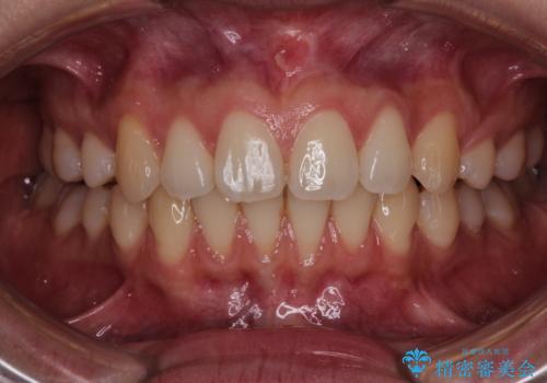 【歯肉退縮】歯茎の移植を行なった症例。の治療前