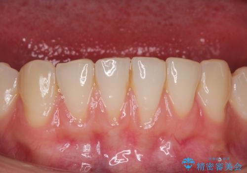【オールセラミック】下の前歯が痛い。の治療前