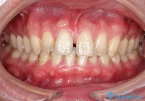 【インビザライン】前歯の隙間を治したい。の症例 治療前