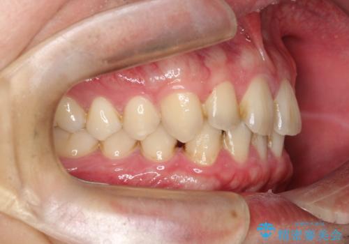 【インビザライン】前歯の隙間を治したい。の治療前