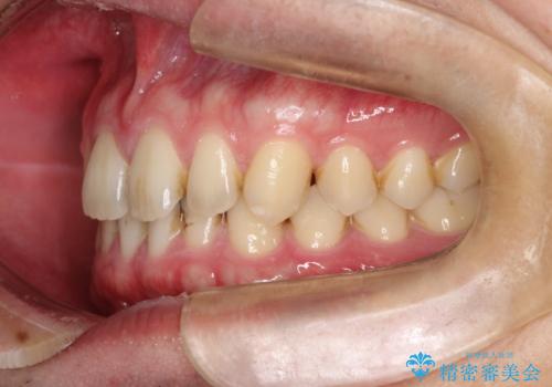 【インビザライン】前歯の隙間を治したい。の治療前