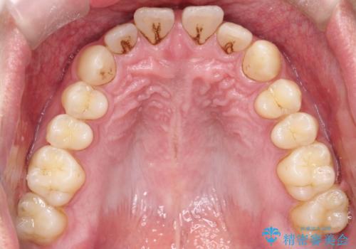 【インビザライン】前歯の隙間を治したい。の治療前