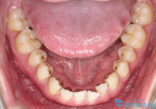 【インビザライン】前歯の隙間を治したい。の治療前