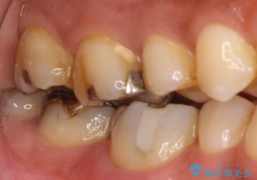 【オールセラミック】歯がズキズキ痛い。の治療前