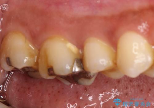 【オールセラミック】歯がズキズキ痛い。の治療前