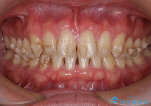 【インビザライン】前歯の隙間を治したい。の治療中