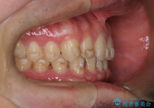 【インビザライン】前歯の隙間を治したい。の治療中