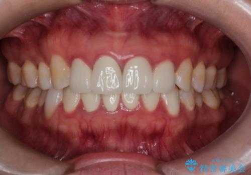 【オールセラミック】下の前歯が痛い。の治療前