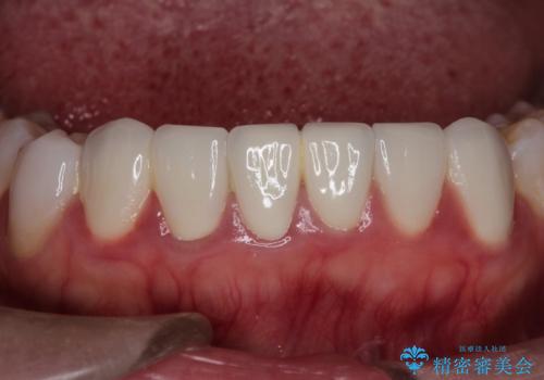 【オールセラミック】下の前歯が痛い。の治療前