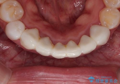 【オールセラミック】下の前歯が痛い。の治療前