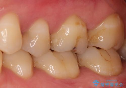 【精密根管治療】奥歯がズキズキ痛い。の治療前