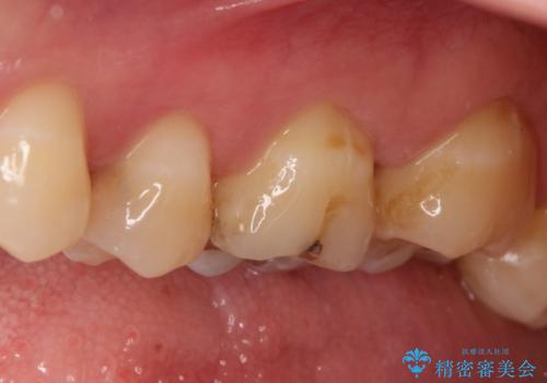 【精密根管治療】奥歯がズキズキ痛い。の治療前