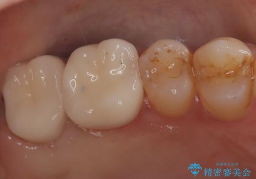 【オールセラミック】歯がズキズキ痛い。の症例 治療後