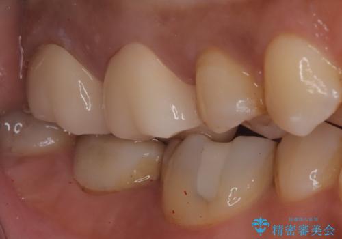 【オールセラミック】歯がズキズキ痛い。の治療後