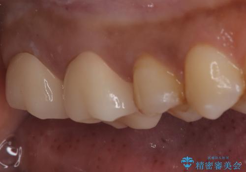 【オールセラミック】歯がズキズキ痛い。の治療後